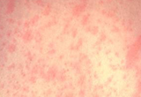 Measles rash on light skin.