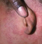Measles rash on dark skin.