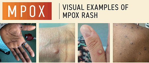 Visual examples of mpox rash. Rash looks like pimples or blisters on hands, feet and back.